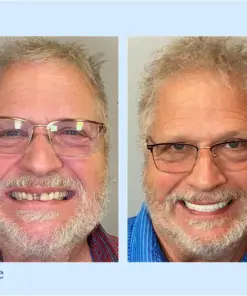 Hidone® --🦷Advanced Customized Full Denture Set🦷