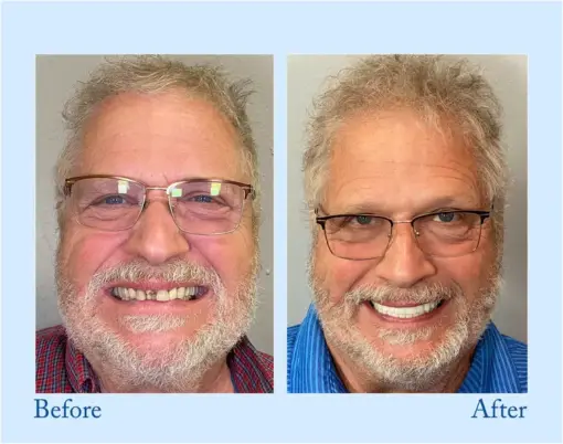 Hidone® --🦷Advanced Customized Full Denture Set🦷