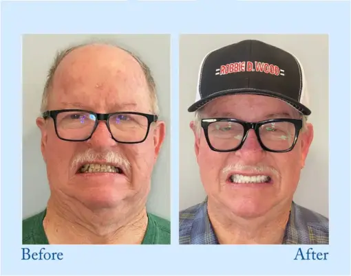 Hidone® --🦷Advanced Customized Full Denture Set🦷