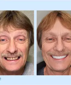 Hidone® --🦷Advanced Customized Full Denture Set🦷