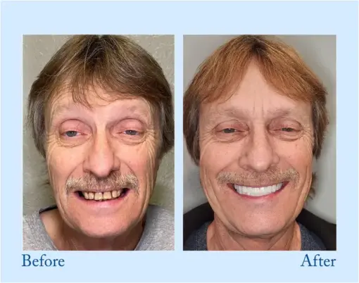 Hidone® --🦷Advanced Customized Full Denture Set🦷