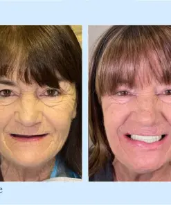Hidone® --🦷Advanced Customized Full Denture Set🦷