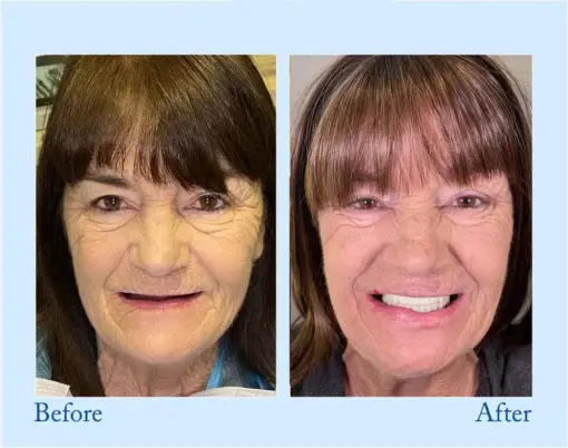 Hidone® --🦷Advanced Customized Full Denture Set🦷