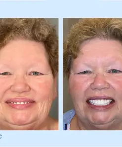 Hidone® --🦷Advanced Customized Full Denture Set🦷