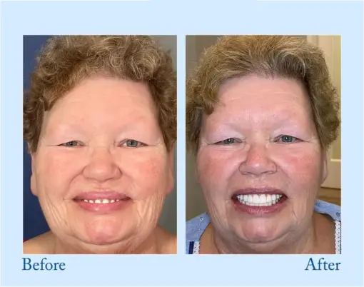 Hidone® --🦷Advanced Customized Full Denture Set🦷