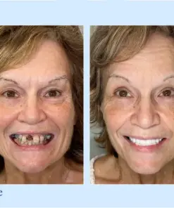 Hidone® --🦷Advanced Customized Full Denture Set🦷