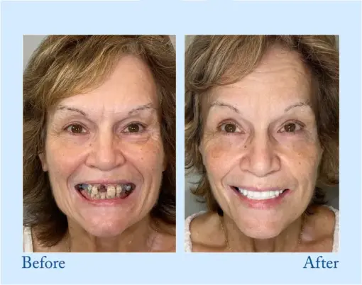 Hidone® --🦷Advanced Customized Full Denture Set🦷