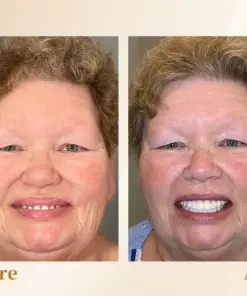 Hidone® --🦷Advanced Customized Full Denture Set🦷 (⏰Limited time discount last 30 minutes⏰)💎💎